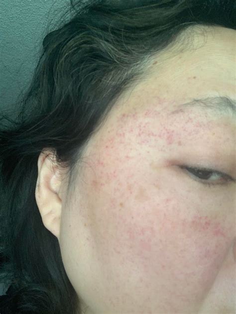 Petechiae all over face after surgery : r/DermatologyQuestions