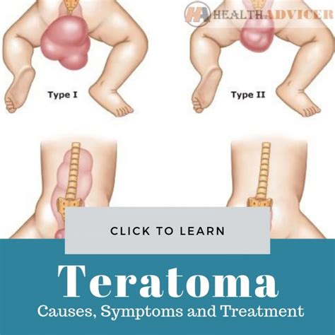 Teratoma: Causes, Picture, Symptoms, Diagnosis And Treatment