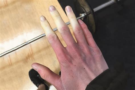 Drug-induced Raynaud’s phenomenon ‘probably underestimated’ - The ...