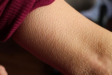 Skin Goosebumps Stock Photo - Download Image Now - iStock