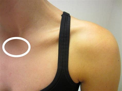 SC dislocation: Mechanism of injury and treatment of a sternoclavicular dislocation | Dr Geier