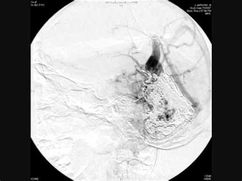 Cerebellar AVM post embo.wmv - YouTube