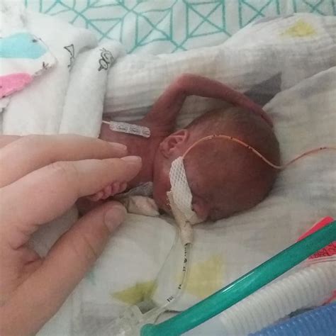 Baby Born at 21 Weeks Defies the Odds, Becomes One of the Youngest Babies to Survive