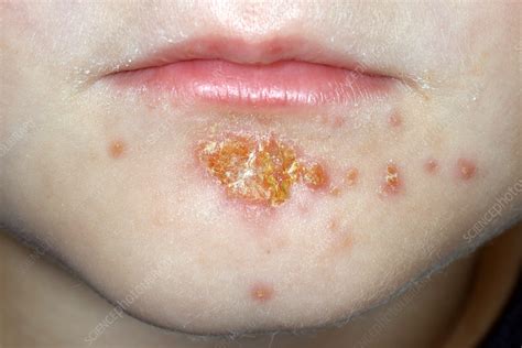 Picture Of Impetigo On Lips | Lipstutorial.org