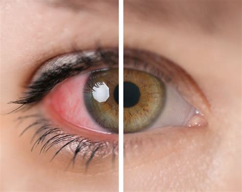 Uveitis Symptoms & Diagnosis: Expert Insights from Infinity Retina