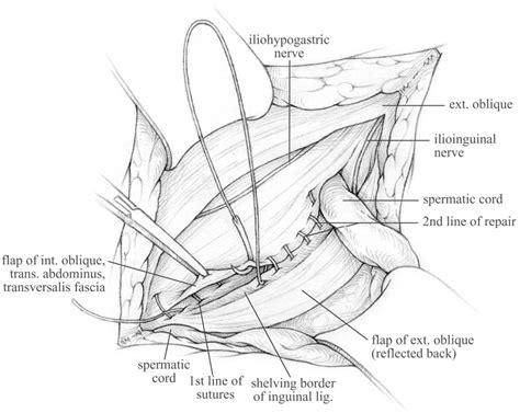 Figure 7 from The Shouldice repair for groin hernias. | Semantic Scholar