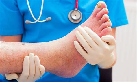 How is a diabetic foot infection treated? - FITPAA