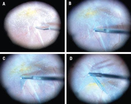 Pearls for epiretinal membrane peeling