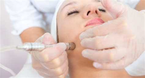 Is Microdermabrasion an Effective Treatment for Acne Scars