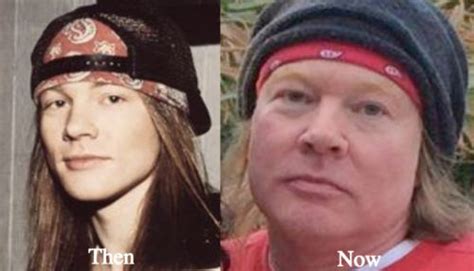 Axl Rose Plastic Surgery Before and After Photos - Latest Plastic ...