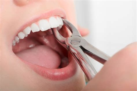 How Long Does Pain Last After Tooth Extraction? | Mango Hill Dental