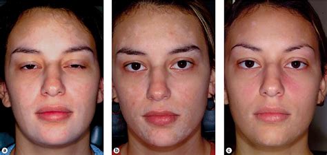 Figure 1 from Repigmentation of Vitiligo with Pimecrolimus Cream: A Case Report | Semantic Scholar