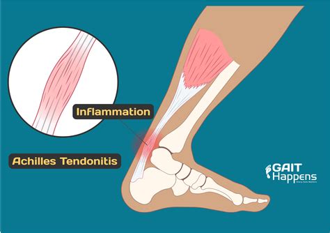 Know the Symptoms of Achilles Tendonitis / Tendinopathy | Gait Happens