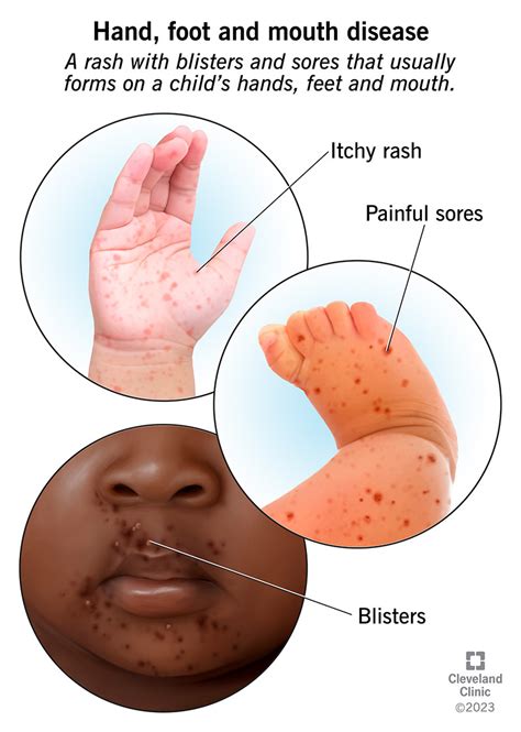 Hand, Foot & Mouth Disease (HFMD): Symptoms & Causes