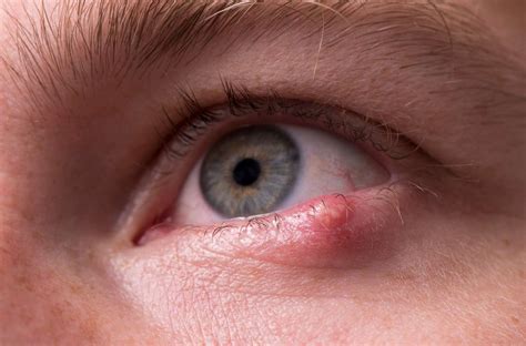 What Is a Stye? Plus, Eye Stye Causes and How to Get Rid of a Stye