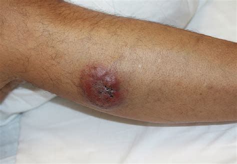 Painless Nodule on the Leg | MDedge Dermatology