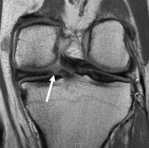 Posterior Horn Medial Meniscus Tear | Knee Specialist | Minnesota