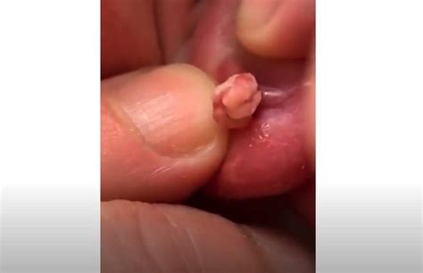 Squirting Earlobe Cyst Drainage : r/pimplepopperdelight