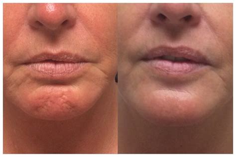 My client loves the new and improved appearance of her chin! Botox is a great way to relax lines ...