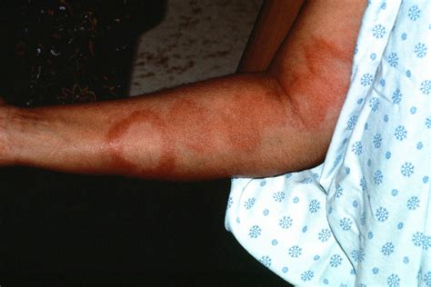 Leprosy disease causes, symptoms, diagnosis, treatment and cure