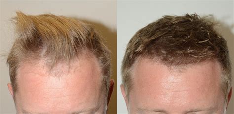 Dr Epstein Fue Hair Transplant 1600 Grafts 1 – Hair Restoration News ...