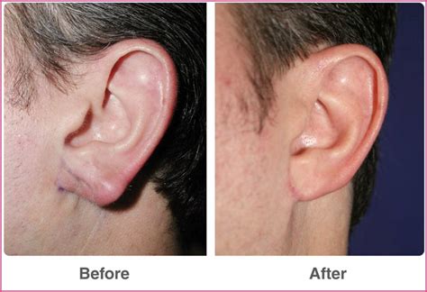 Ear Plastic Surgery – Best Plastic Surgery Before and After