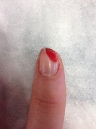 Dr BHB partial finger/nail avulsion PIC | BabyCenter