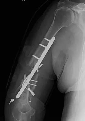 Fracture Nonunions - Information & Treatment