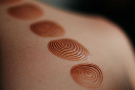 Cupping Marks Explained: Unraveling the Mystery - Wellness Wise Hub