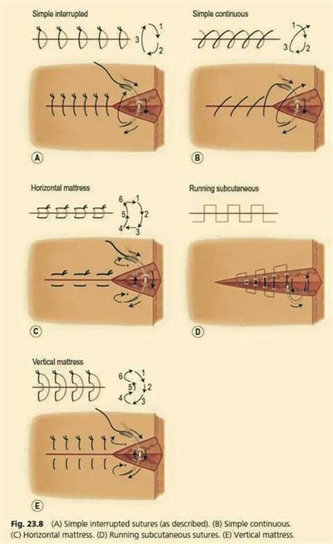 Suture | Medical school studying, Surgical nursing, Surgical suture