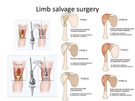 Overview of Limb Salvage Surgery - Life Health Max