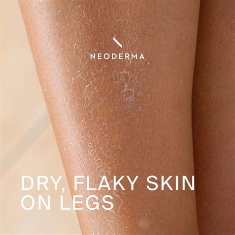 Dry, Flaky Skin on Legs – NEODERMA