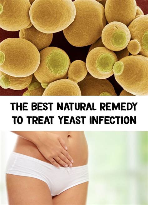 The best natural remedy to treat yeast infection | Yeast infection, Treat yeast infection ...