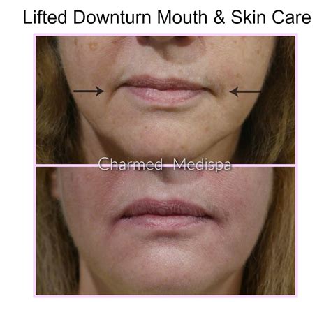 Lifting the Downturn Of the Mouth – Charmed Medispa