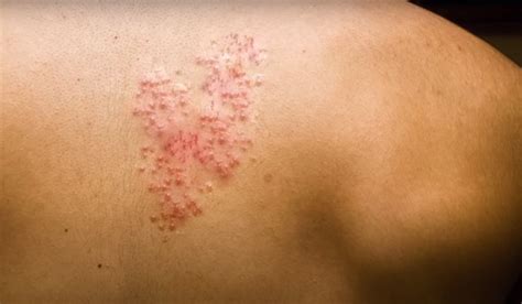 Pain Relief for Shingles: An Enthusiast's Guide - Pain Away Tips