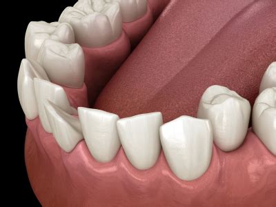 Misaligned teeth: Causes, classification & treatment options