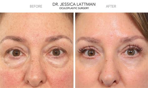 Under Eye Bags | New York Eyelid Blepharoplasty Expert Dr. Jessica Lattman