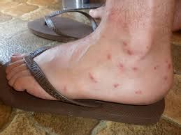 Sand Flea Bites: Photos, Diagnosis, Causes, Risk & Treatments