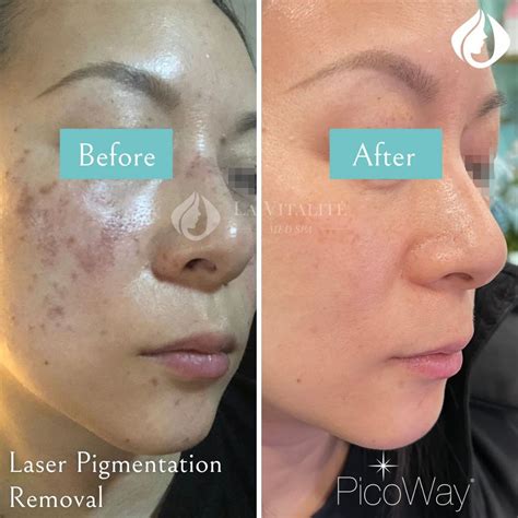 PicoWay® Laser Pigmentation Removal Toronto & North York - La Vitalité Med Spa