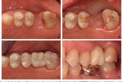 Figure 2 from Minimally invasive prosthetic restoration of posterior ...