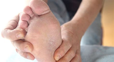 How to Stop, Cure, Itchy Sole of Feet, Causes, Home Remedies