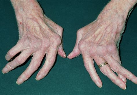 Get Arthritis Rheumatoid Hands Gif Propranolols | My XXX Hot Girl