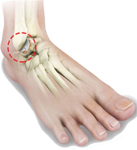 Ankle Arthritis and Your Options • Southwest Florida's Health and ...