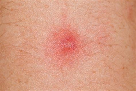 Hpv warts skin tags private parts - verycruise