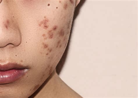 Long-Term Topical Adapalene/Benzoyl Peroxide Gel Reduced Atrophic Acne Scars - Dermatology Advisor