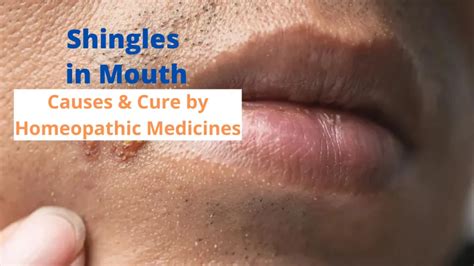 Shingles in Mouth– Symptoms, Causes & Homeopathic Medicines