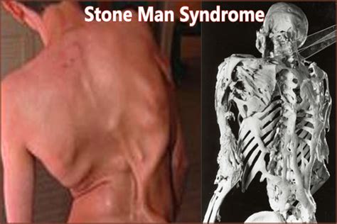 Stone Man Disease Symptoms