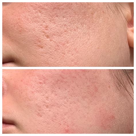 [B&A] 2 months progress on 0.025% tretinoin for acne scarring : r/SkincareAddiction