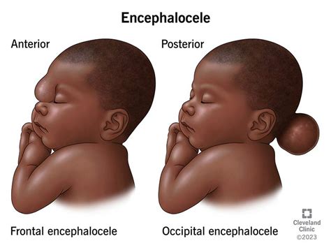 Encephalocele: What It Is, Causes, Treatment & Types