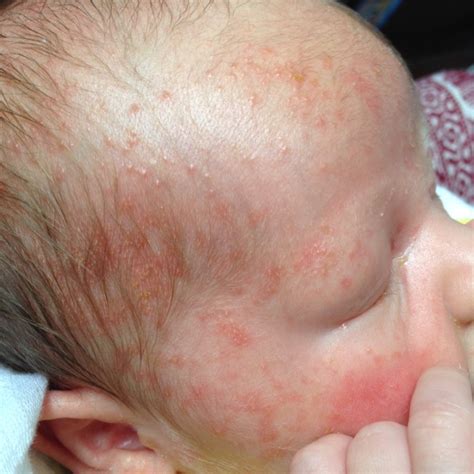 Cradle Cap? Baby Acne? Both? Please help! What to do? I've heard leave ...